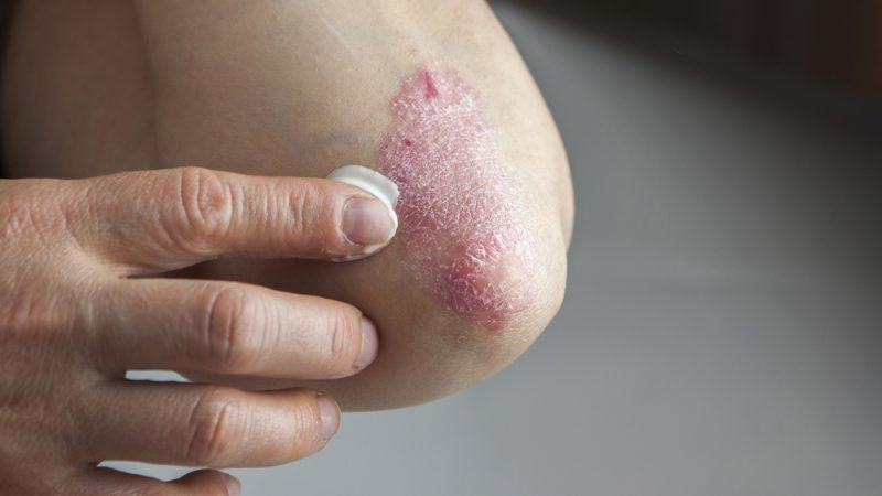 eczema între degete și degetele de la tratament